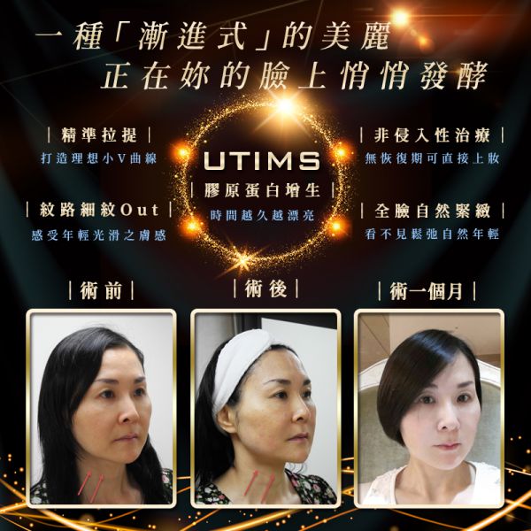 见证年轻：UTIMS音波拉提解决鱼尾纹、抬头 UTIMS音波拉提详解