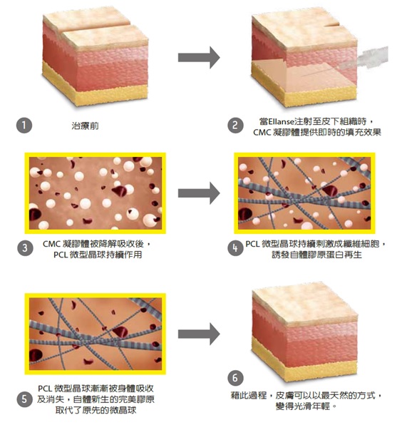 洢莲丝EllANSE依恋诗=舒颜翠3D聚左旋乳酸+玻尿酸+晶亮瓷+胶原蛋白增生的新型注射剂 