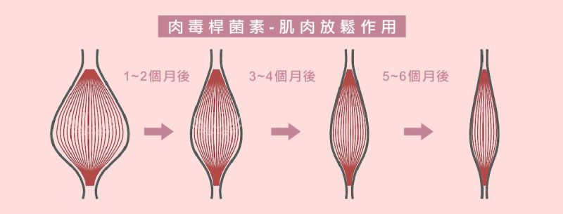 肉毒杆菌素(Botulinum Toxin)一般用于除皱、抬头纹、鱼尾纹、瘦肩