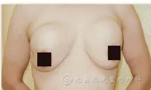 奥美定会致癌吗?奥美定能取出干净吗？