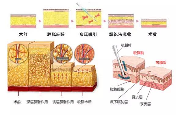 怎样吸脂减肥？局部脂肪堆积和全身性脂肪堆积怎样吸脂减肥？