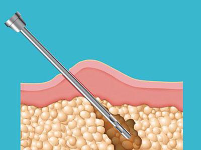 怎样吸脂减肥？局部脂肪堆积和全身性脂肪堆积怎样吸脂减肥？
