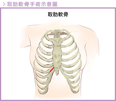 评美网小编吐血推荐：隆鼻材质大全详解（耳软骨肋骨异体骨硅胶隆鼻）