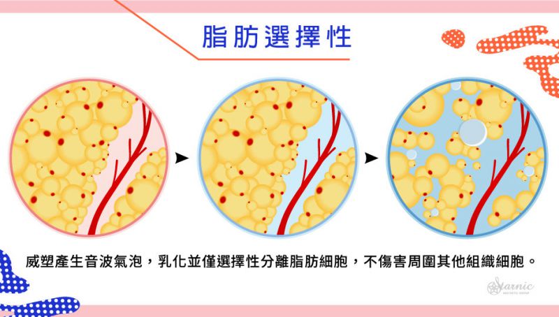 超音波抽脂/ 威塑抽脂的原理及效能和流程是什么样的？ 