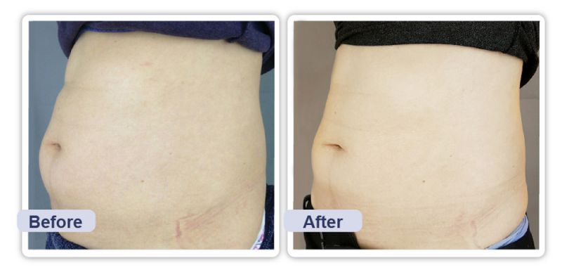 吸脂减肥前后对比图 吸脂减肥前后真实案例图片 吸脂减肥前后对比图 吸脂减肥前后真实案例图片