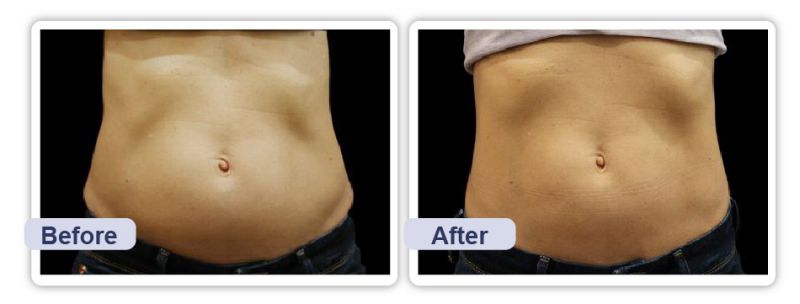 吸脂减肥前后对比图 吸脂减肥前后真实案例图片 吸脂减肥前后对比图 吸脂减肥前后真实案例图片