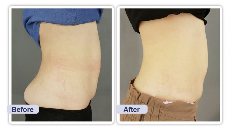 吸脂减肥前后对比图 吸脂减肥前后真实案例图片 吸脂减肥前后对比图 吸脂减肥前后真实案例图片