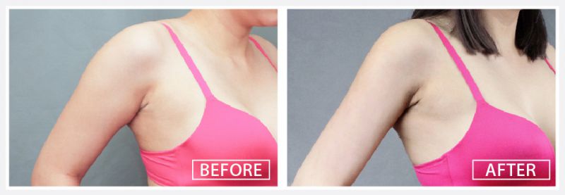 吸脂减肥前后对比图 吸脂减肥前后真实案例图片 吸脂减肥前后对比图 吸脂减肥前后真实案例图片