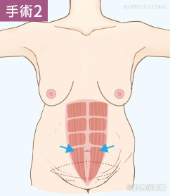 怀孕产后的腹部赘肉松弛和乳房下垂怎么办？腹部拉皮+隆胸TABA二合一