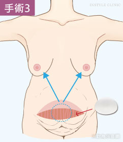 怀孕产后的腹部赘肉松弛和乳房下垂怎么办？腹部拉皮+隆胸TABA二合一