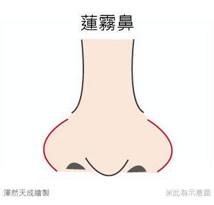 鼻翼太宽、太厚、太大怎么办？微创缩鼻翼手术简介