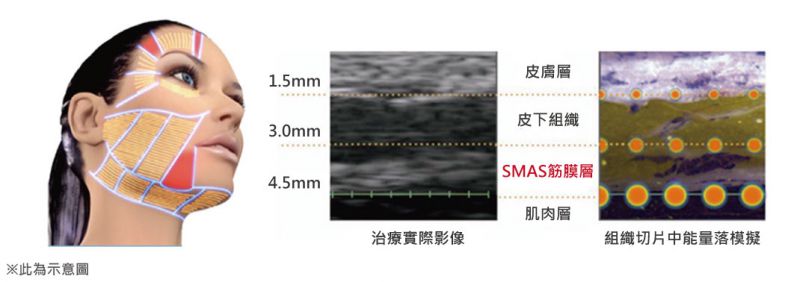 音波拉提（拉皮）的作用原理是什么？有哪些优点？