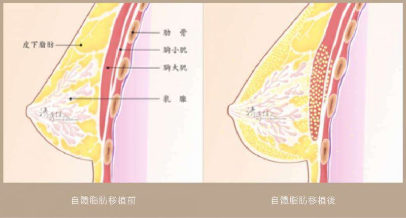 自体脂肪隆胸手术过程是怎样的？自体脂肪隆胸注意事项有哪些？