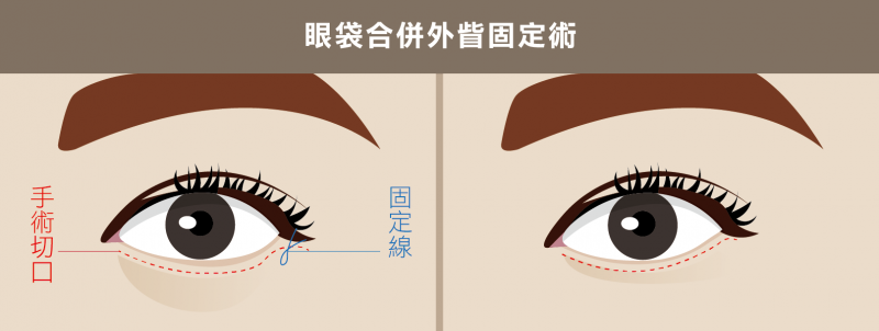 眼袋成因和严重程度不一样手术方式一样吗？去眼袋手术方式大全