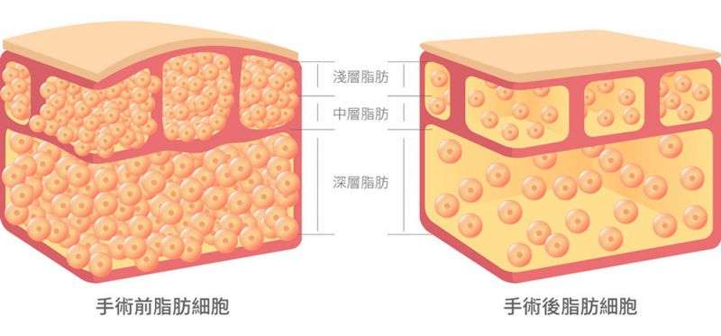 雷射减脂和复合式抽脂该如何选择？