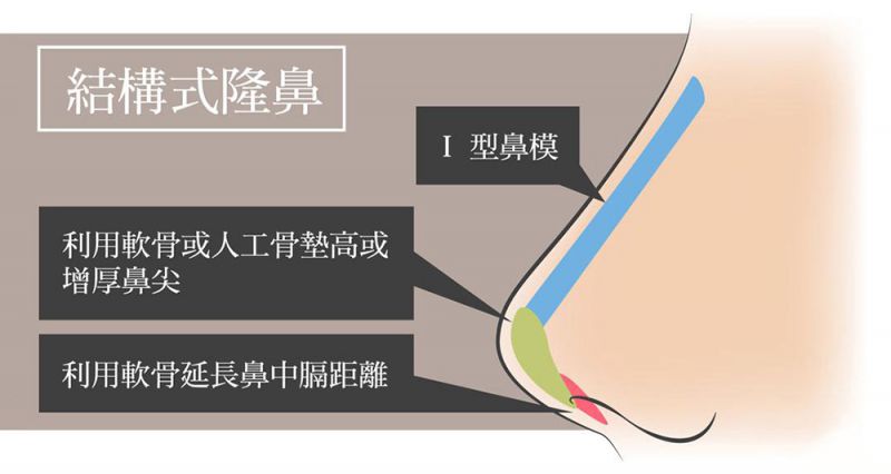 为什么要选择结构式隆鼻？传统隆鼻有什么缺点？