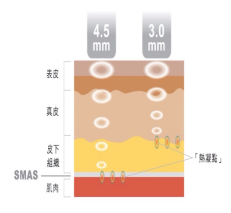 眼袋大眼皮下垂双下巴怎么办？韩国HIFU瘦双下巴Utims A3