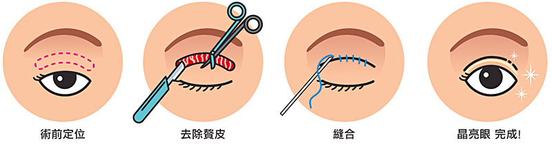 哪些人适合割双眼皮（全切双眼皮）？