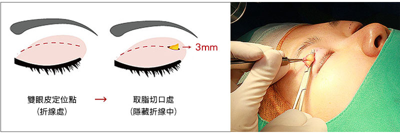 什么是肿泡眼(泡泡眼)?先天性和后天性的泡泡眼手术方式一样吗？