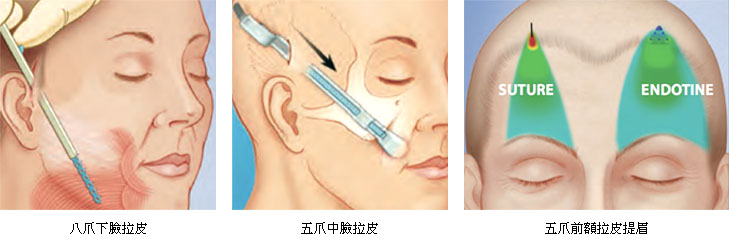 为什么变老，是因为胖瘦吗？老态主要是面部下垂！传统拉皮和五爪八爪拉皮