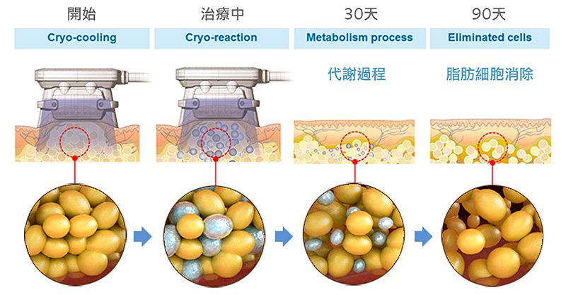 Coolshaping 酷立塑冷冻减脂效果怎么样？