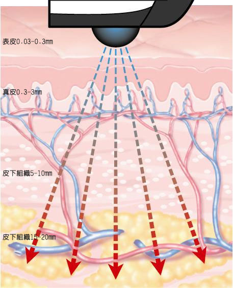 热拉提操作原理与方式是怎么样的？热拉提疗程及注意事项有哪些？