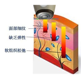 全脸提升手术埋线全脸提升vs热拉提全脸提升vs小切口全脸提升哪个效果最好？