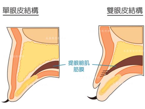 眼皮松弛提眼睑肌无力大小眼泡泡眼适合哪种双眼皮手术？