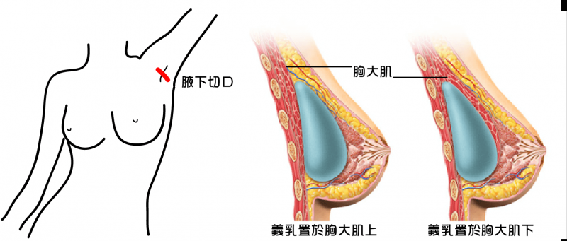 假体隆胸果冻硅胶隆胸盐水袋假体丰胸哪个效果好？