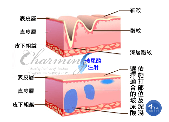 哪些部位适合打玻尿酸？玻尿酸注射术前术后注意事项有哪些？