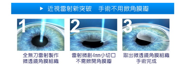 ReLEx smile近视全飞秒激光快速知识库（近视全飞秒激光真实案例）