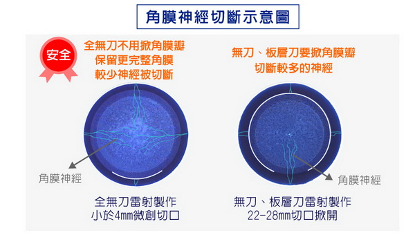 ReLEx smile近视全飞秒激光快速知识库（近视全飞秒激光真实案例）