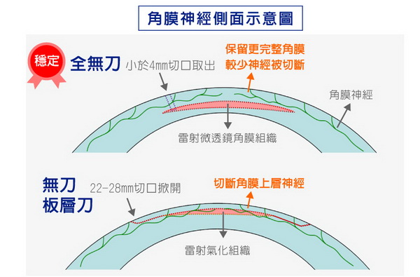 ReLEx smile近视全飞秒激光快速知识库（近视全飞秒激光真实案例）