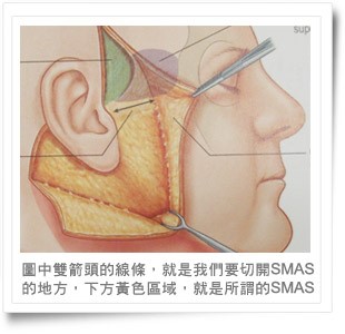 音波拉皮疗程需要多久时间？音波拉皮治疗的疼痛感会很高吗？恢复期？