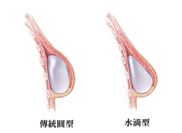 新型水滴型果冻硅胶假体，创造自然水滴胸型