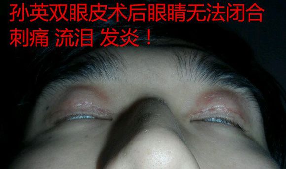 上海九院孙英双眼皮毁容不能睁眼后悔案例