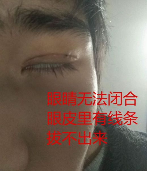 上海九院孙英双眼皮毁容不能睁眼后悔案例