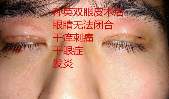 上海九院孙英双眼皮毁容不能睁眼后悔案例