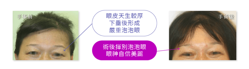 前额内视镜拉皮手术是什么？前额内视镜拉皮注意事项和手术案例