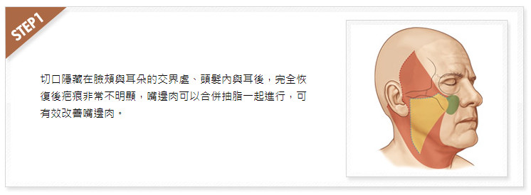 哪种面部拉皮手术恢复消肿期最短？郁金香拉皮Tuliplift